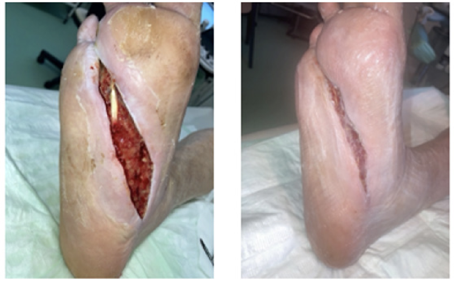 Foot incision wound due to gangrene and infection, and 1 month later