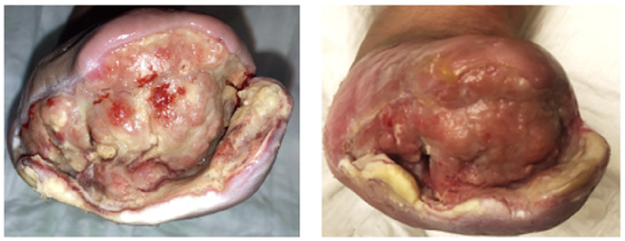 Forefoot amputation wound due to gangrene and diabetes infection, and 1 month later