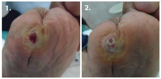 Diabetic foot ulcer before Abilar&reg; treatment and 1 month later