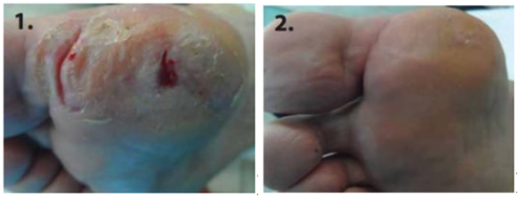 Diabetic foot ulcer before Abilar&reg; treatment and 1 month later