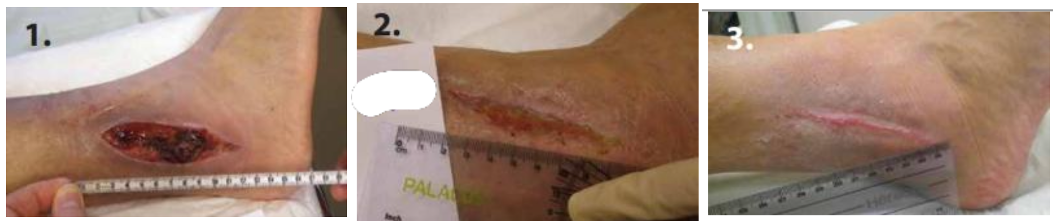 Complicated surgical wound before Abilar&reg; treatment, 1 month progress, and 3 months after complete healing