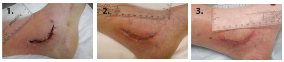 Complicated surgical wound before Abilar&reg; treatment, 1 month progress, and 2 months after complete healing