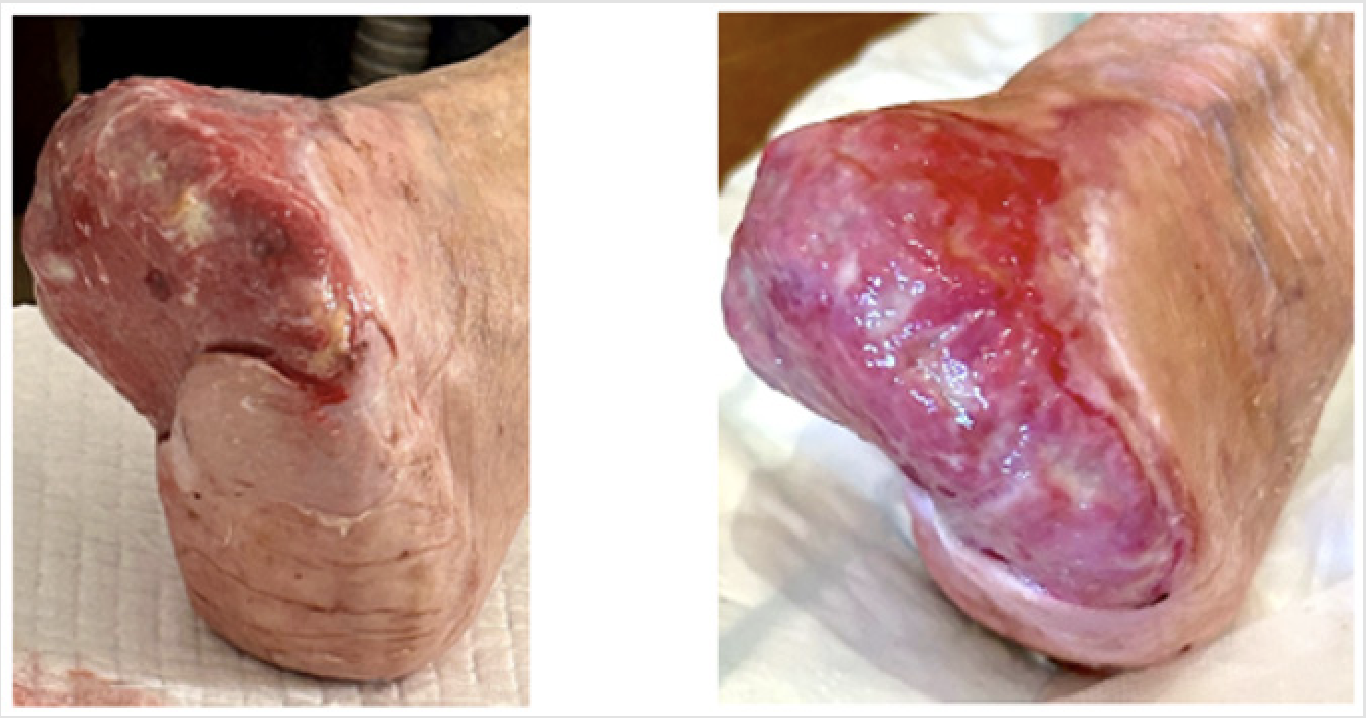 Forefoot amputation wound due to arterial occlusion and gangrene, and 1 month later