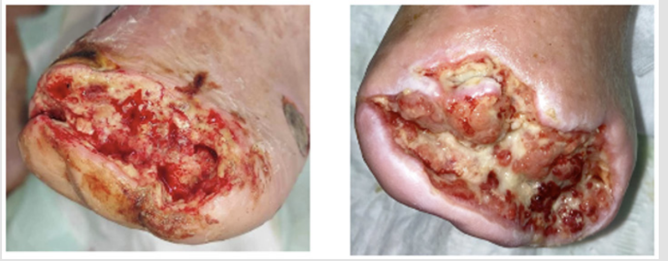 Forefoot amputation wound due to arterial occlusion and gangrene, and 1 month later